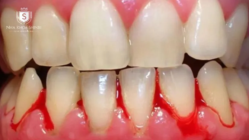 Tác động của bệnh suy thận đến sức khỏe răng miệng Tác động của bệnh suy thận đến sức khỏe răng miệng