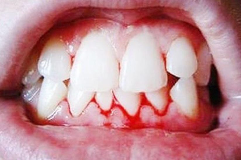 tai-sao-lai-can-bac-si-nha-khoa-chuyen-phuc-hinh-rang-cho-nguoi-benh-ung-thu tai-sao-lai-can-bac-si-nha-khoa-chuyen-phuc-hinh-rang-cho-nguoi-benh-ung-thu