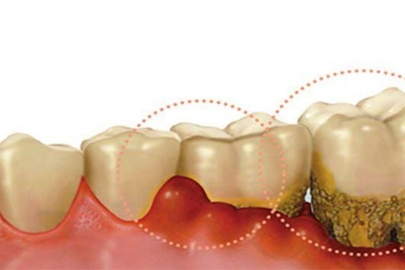 Viêm lợi nhẹ cũng có thể ảnh hưởng đến việc trồng răng