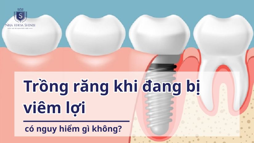 Trồng răng khi đang bị viêm lợi có nguy hiểm gì không?
