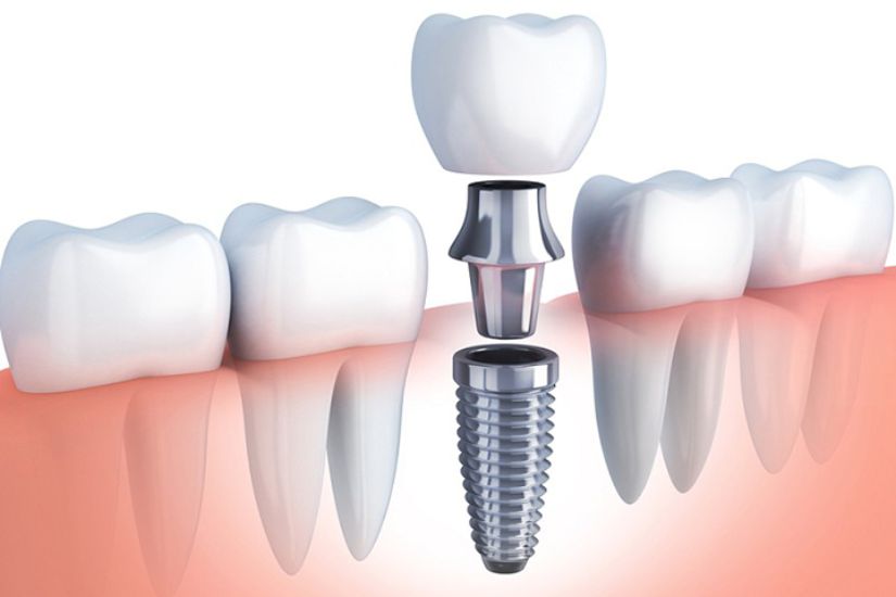 Trồng răng Implant là giải pháp phục hình răng mất tối ưu, đặc biệt phù hợp với người đã điều trị ung thư