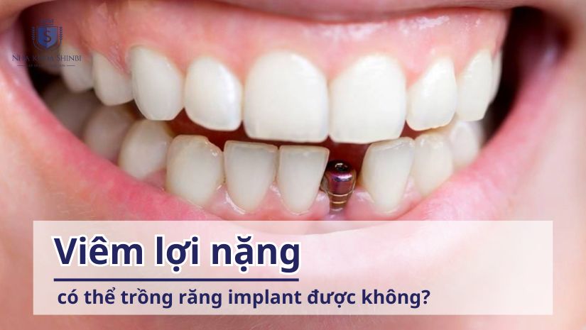 Viêm lợi nặng có thể trồng răng implant được không?