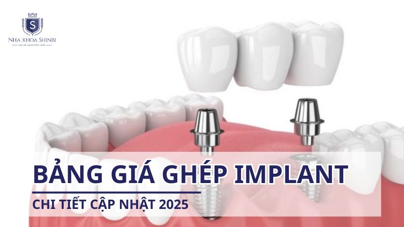 Bảng giá cấy ghép implant chi tiết cập nhật 2025