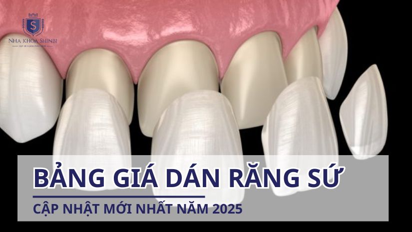 Bảng giá dán răng sứ thẩm mỹ cập nhật mới nhất