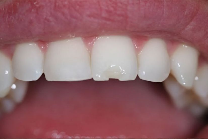 Bị nứt, vỡ, mẻ Bị nứt, vỡ, mẻ