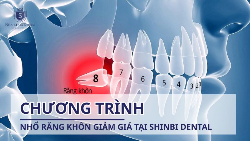 Chương trình nhổ răng khôn giảm giá tại Shinbi Dental