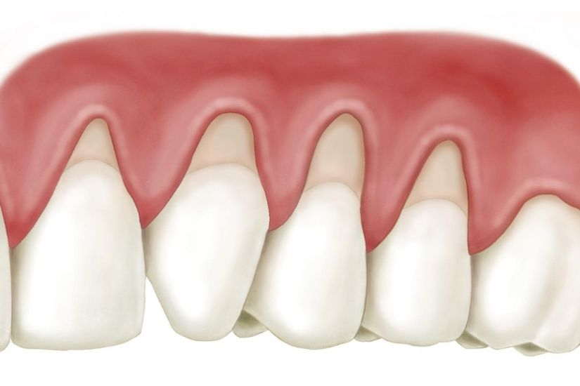 Gây viêm lợi tái phát nhiều lần Gây viêm lợi tái phát nhiều lần