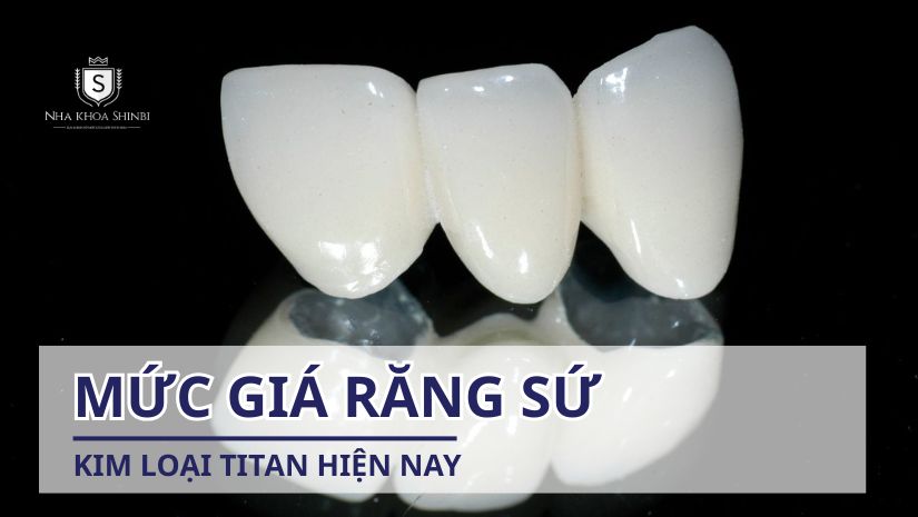 Mức giá răng sứ kim loại titan hiện nay