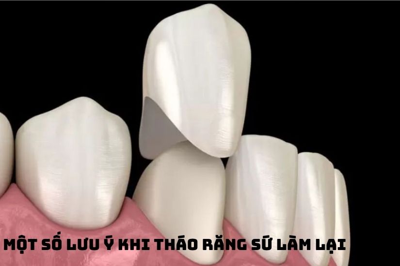 Một số lưu ý khi tháo răng sứ làm lại Một số lưu ý khi tháo răng sứ làm lại