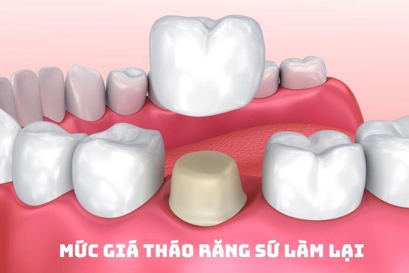 Mức giá khi tháo răng sứ làm lại Mức giá khi tháo răng sứ làm lại