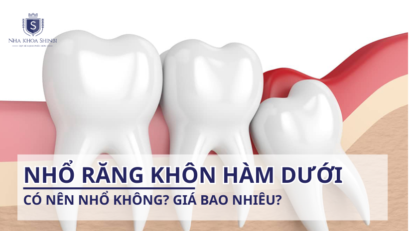 Nhổ răng khôn hàm dưới bao nhiêu tiền? Có nên nhổ không?