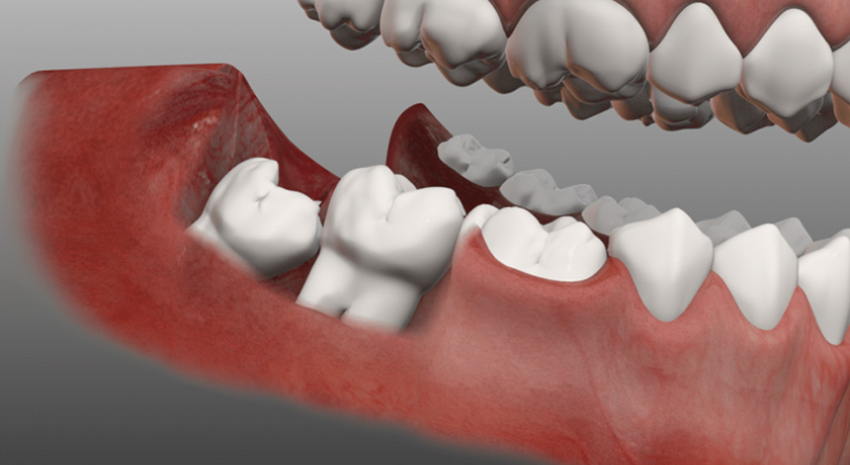 Nhổ răng khôn hàm dưới là gì? Nhổ răng khôn hàm dưới là gì?
