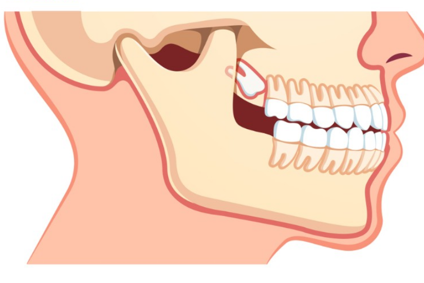 Nhổ răng khôn hàm trên là gì? Nhổ răng khôn hàm trên là gì?