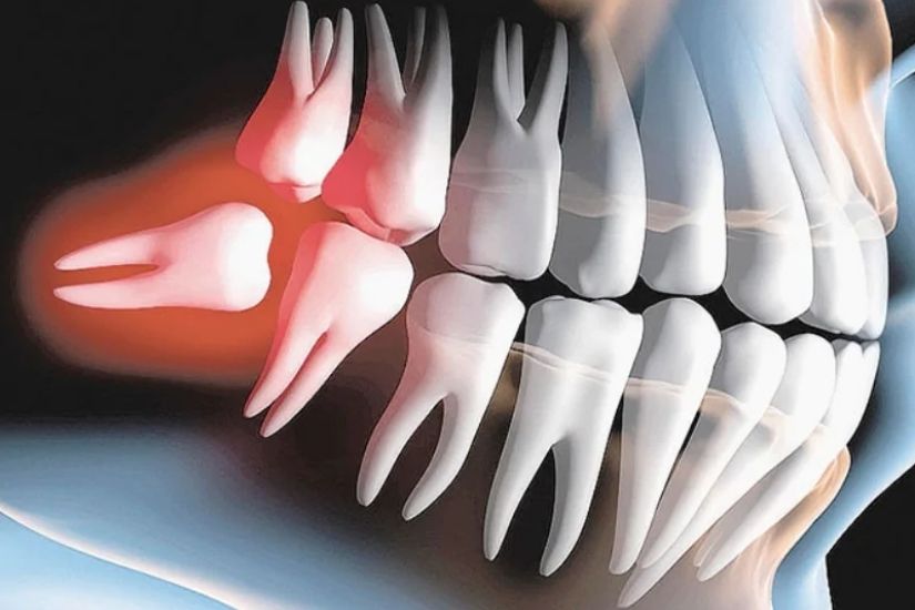 Những bất tiện mà răng khôn mang lại Những bất tiện mà răng khôn mang lại