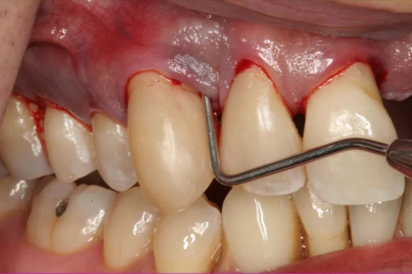 Những lưu ý khi lựa chọn phòng khám điều trị viêm nha chu tại Hà Nội Những lưu ý khi lựa chọn phòng khám điều trị viêm nha chu tại Hà Nội