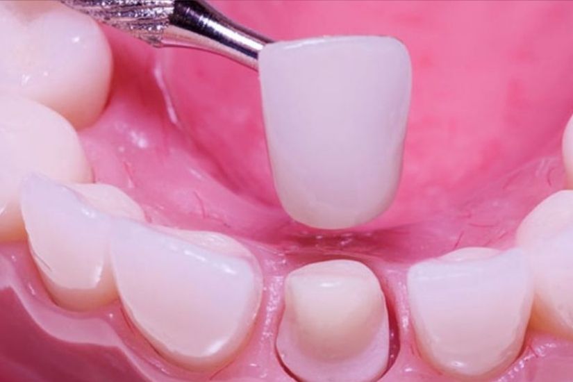 Những nguy cơ rủi ro khi tháo răng sứ làm lại Những nguy cơ rủi ro khi tháo răng sứ làm lại