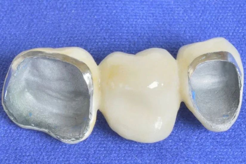 Răng sứ kim loại titan là gì? Răng sứ kim loại titan là gì?