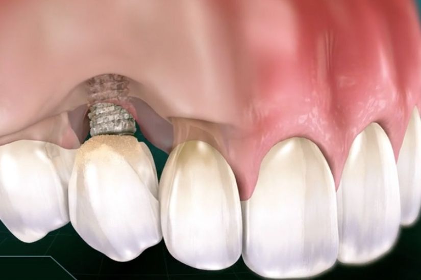 tai-sao-cay-ghep-implant-lai-co-chi-phi-cao-hon-cac-phuong-phap-khac tai-sao-cay-ghep-implant-lai-co-chi-phi-cao-hon-cac-phuong-phap-khac