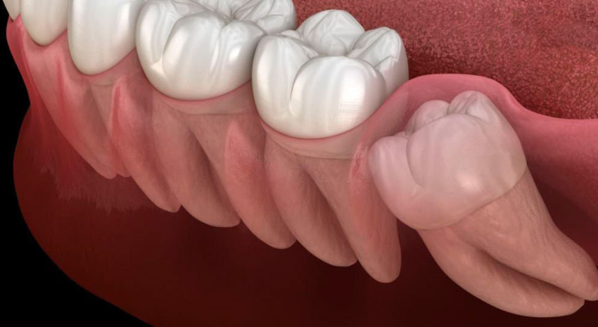 Tại sao phải nhổ răng khôn mọc lệch?