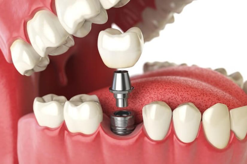 Tiểu phẫu, cấy ghép implant Tiểu phẫu, cấy ghép implant