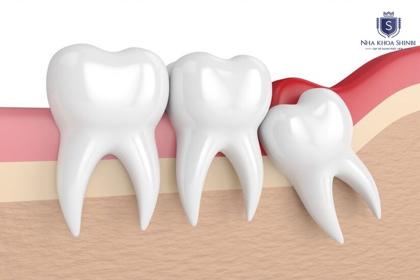 Chi phí nhổ răng khôn ở khu vực Hoàng Mai