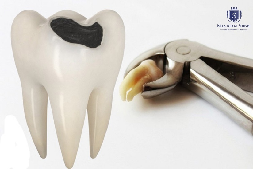 Quy trình nhổ răng khôn tại Hoàng Mai an toàn