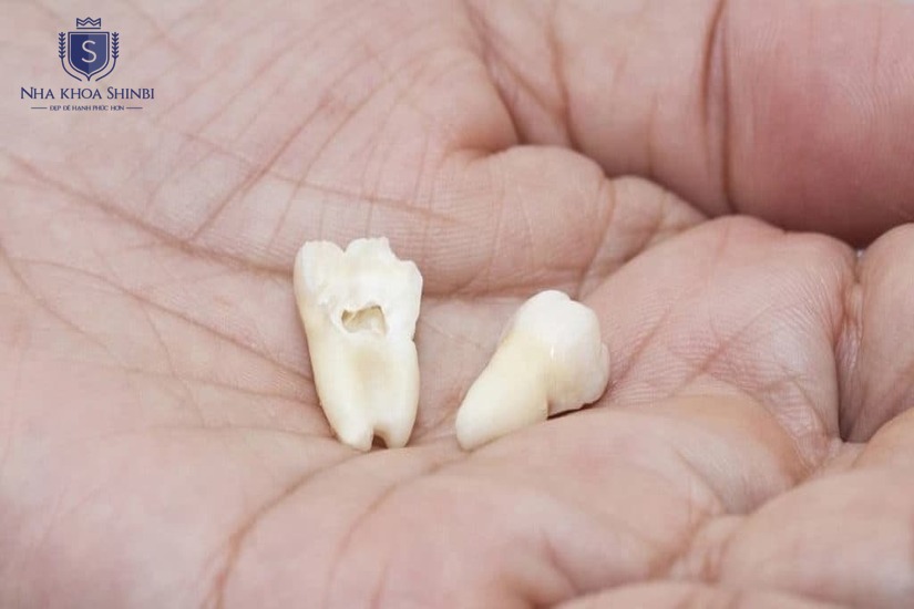 Mỗi ca nhổ răng đều bắt đầu từ bước kiểm tra