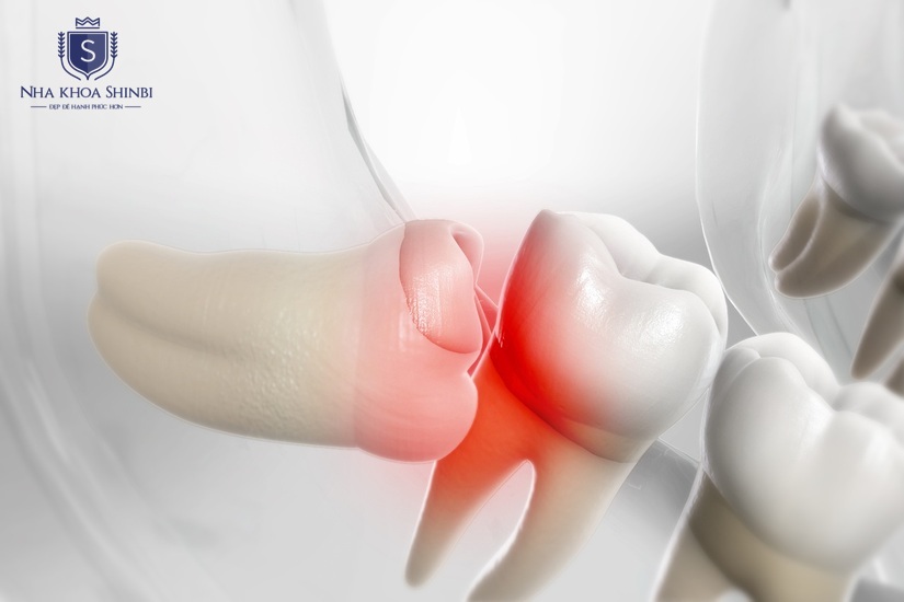 Báo giá cụ thể theo từng trường hợp