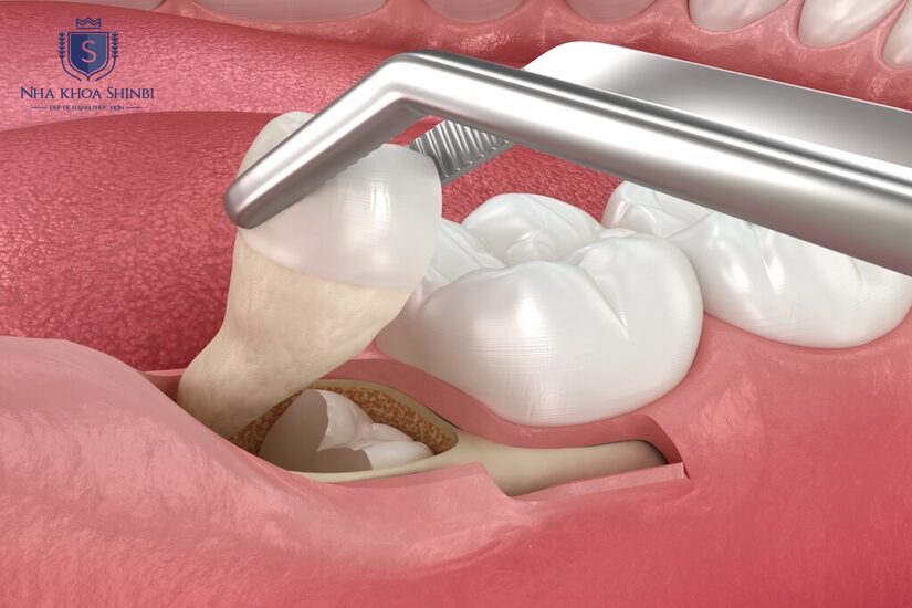 Nhổ răng khôn để tránh biến chứng