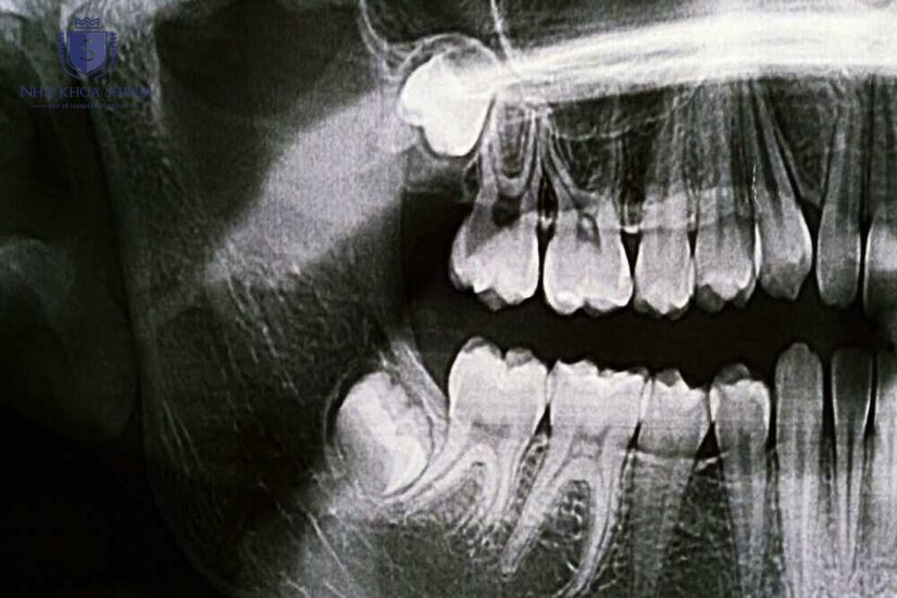 Xác định vị trí và kế hoạch điều trị bằng phim X-quang