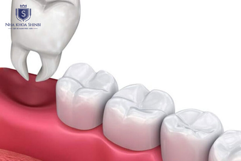 Nhổ răng khôn để giữ hàm răng khỏe mạnh