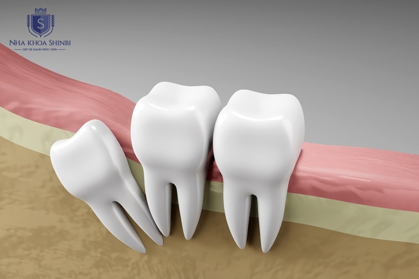 Chụp phim X-quang giúp đánh giá tình trạng răng khôn