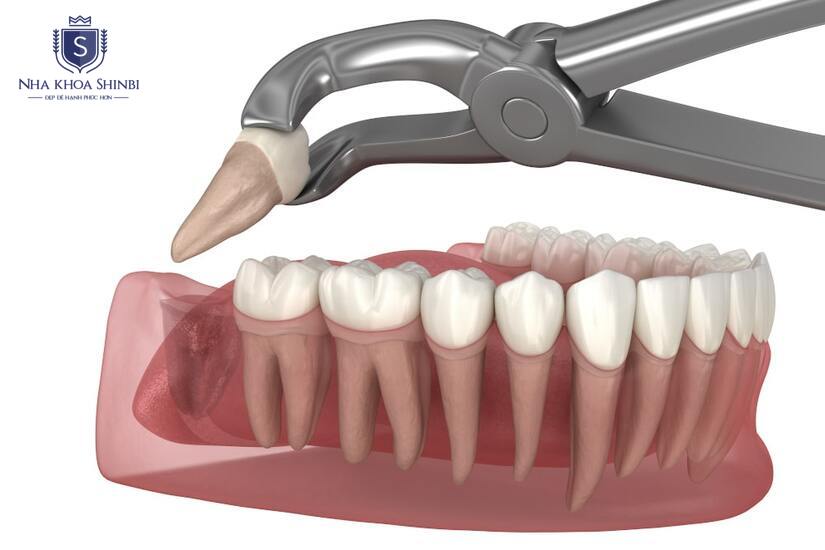 Bác sĩ sử dụng thiết bị tiên tiến để hỗ trợ quá trình nhổ răng