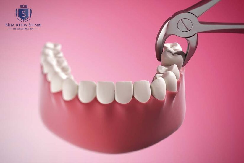 Nhổ răng khôn bằng công nghệ hiện đại, nhanh chóng và nhẹ nhàng