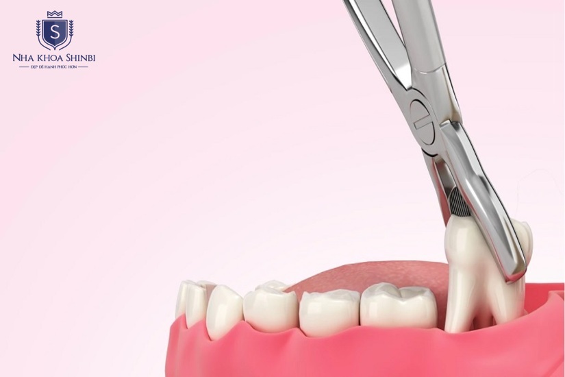 Nhổ răng khôn giúp bảo vệ sức khỏe răng miệng