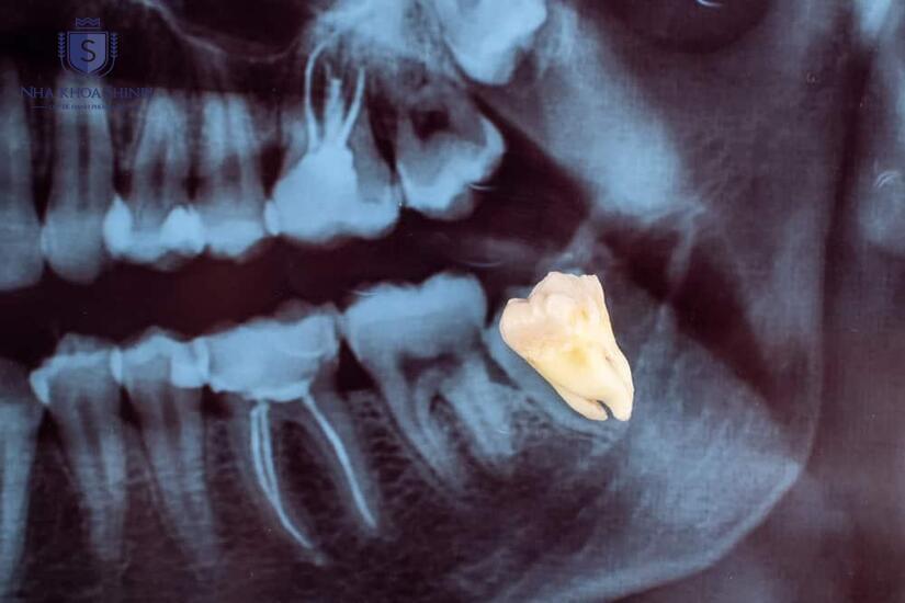 Nhổ răng cần thực hiện theo đúng quy trình kiểm tra