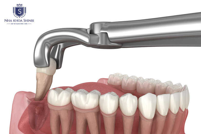 Trang thiết bị hiện đại giúp quá trình nhổ răng diễn ra êm ái hơn