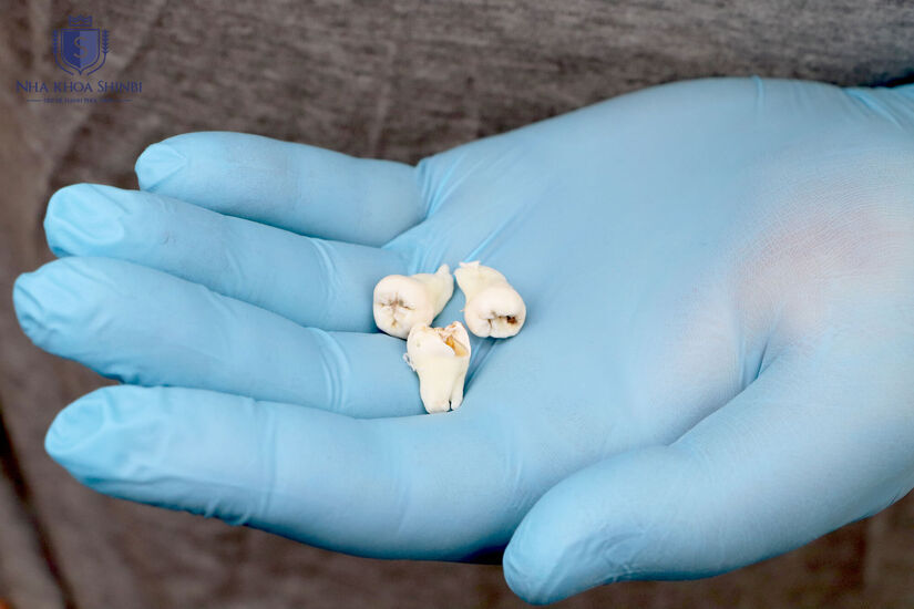 Nhổ răng khôn với mức phí hợp lý tại phòng khám uy tín