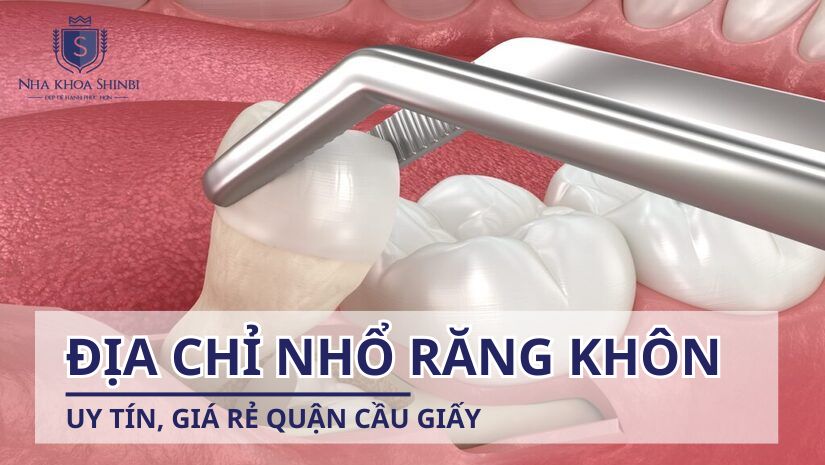 Địa chỉ nhổ răng khôn uy tín, giá rẻ quận Cầu Giấy