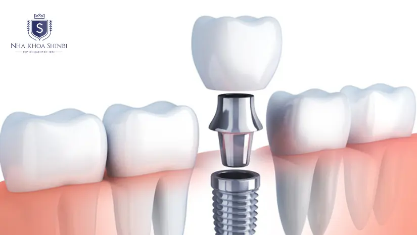 Cách làm răng sứ vĩnh viễn? Chọn phương pháp nào tốt nhất