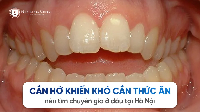 Cắn hở khiến khó cắn thức ăn nên tìm chuyên gia ở đâu tại Hà Nội