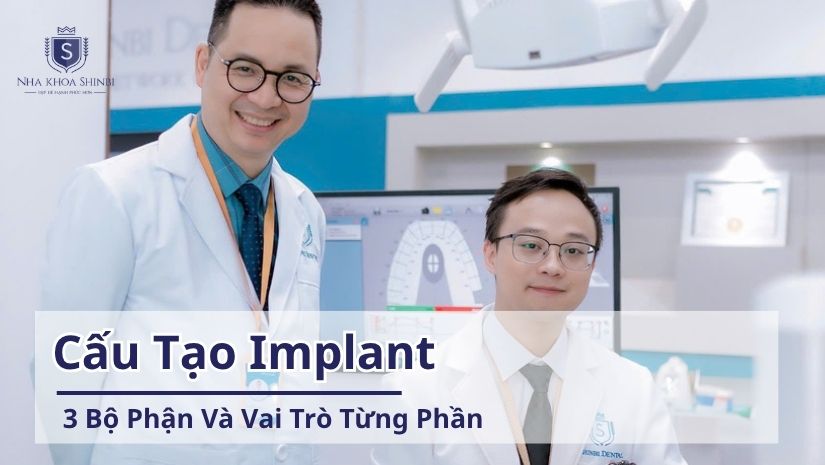 Cấu Tạo Implant: 3 Bộ Phận Và Vai Trò Từng Phần