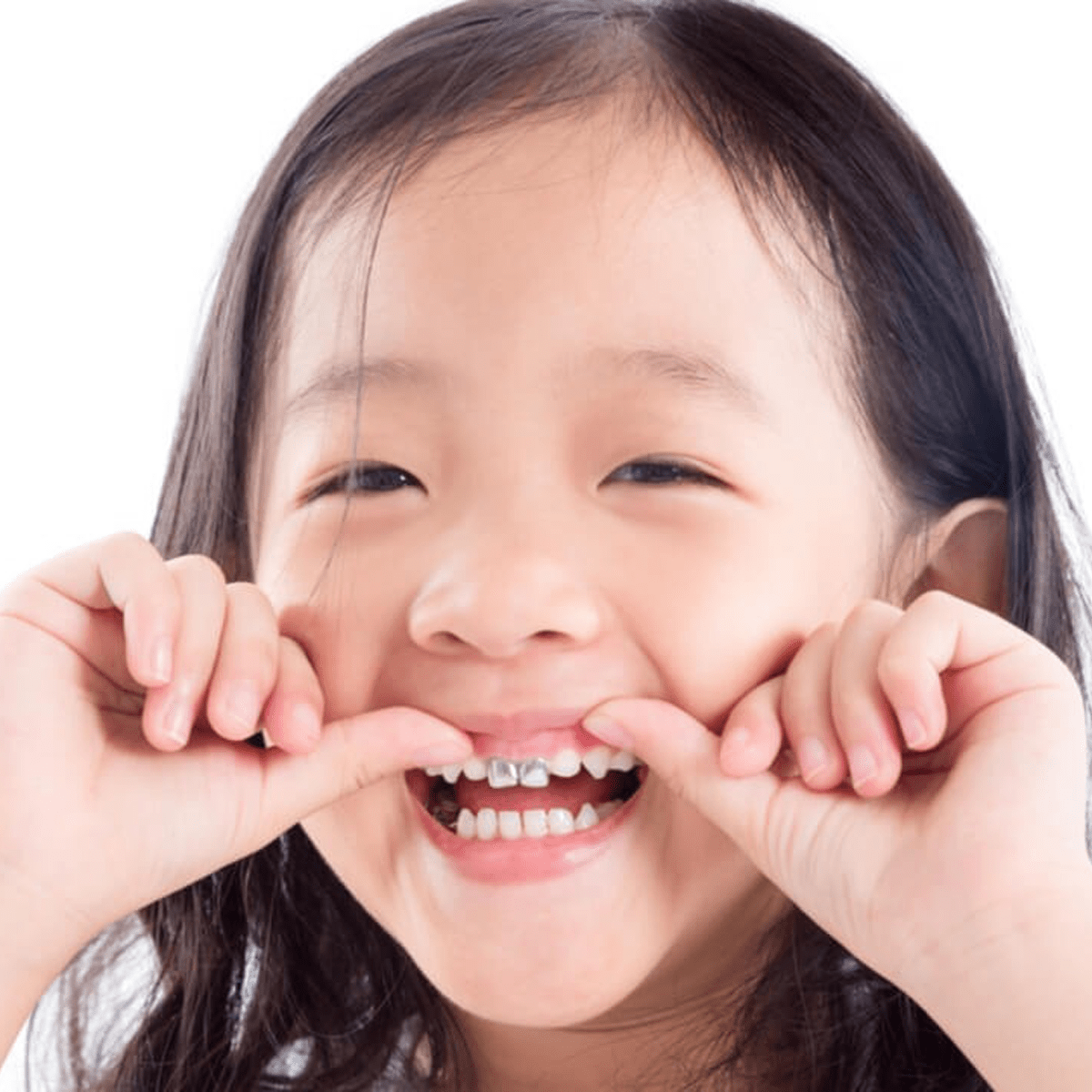 Chụp mão kim loại răng sữa cá nhân hóa