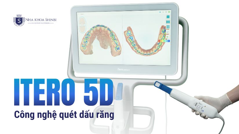Công nghệ quét dấu răng iTero 5D hiện đại nhất thế giới