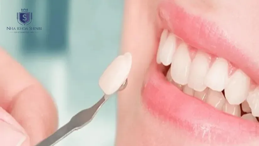 Dán răng sứ Veneer có tốt không? Ưu nhược điểm