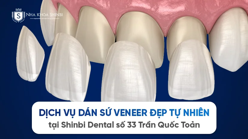 Dịch vụ dán sứ Veneer đẹp tự nhiên tại Shinbi Dental số 33 Trần Quốc Toản