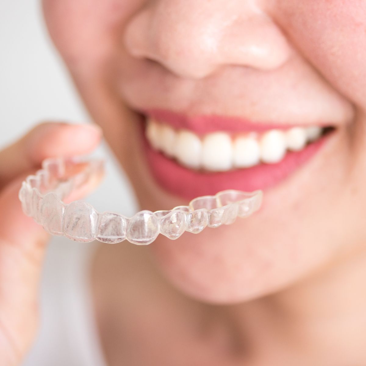 Niềng trong suốt Invisalign Lite một hàm