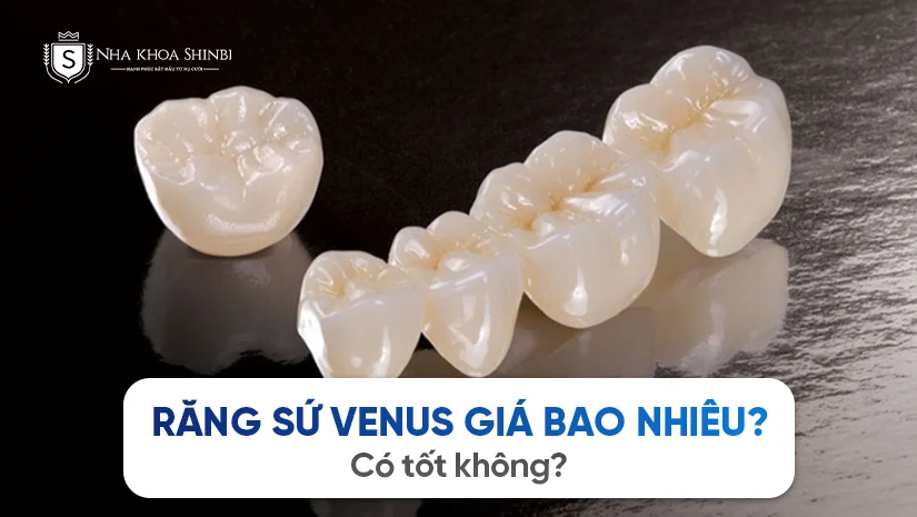 Răng sứ Venus giá bao nhiêu? Có tốt không?