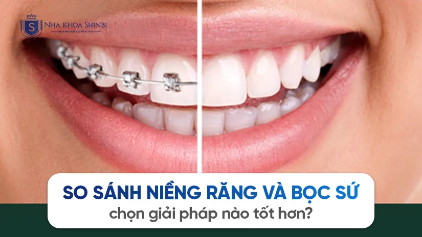 So sánh Niềng răng và Bọc sứ: chọn giải pháp nào tốt hơn?