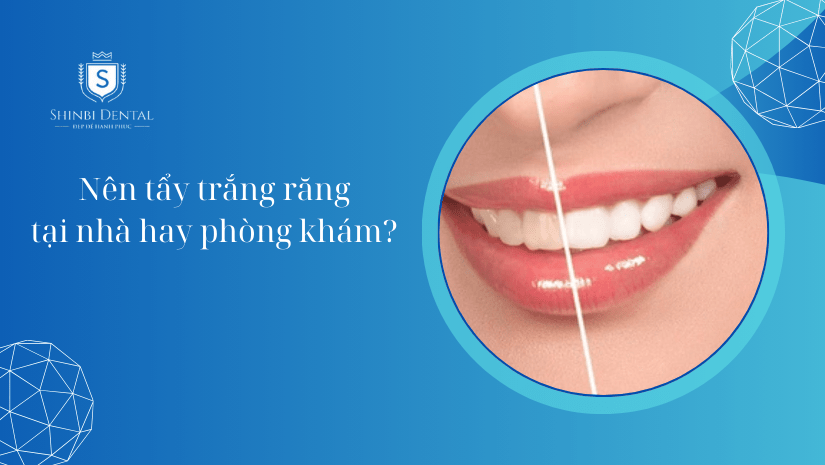 Nên tẩy trắng răng tại nhà hay phòng khám? [Hỏi - Đáp]